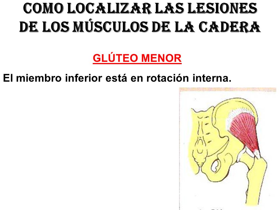 Como localizar las lesiones de los músculos de la cadera
