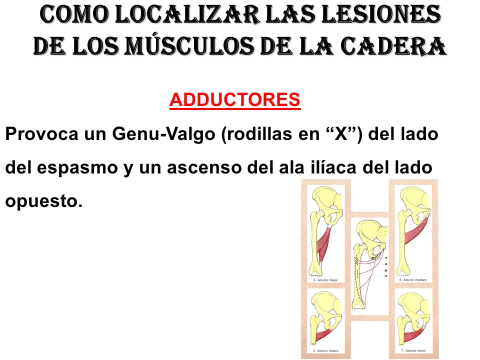 Como localizar las lesiones de los músculos de la cadera