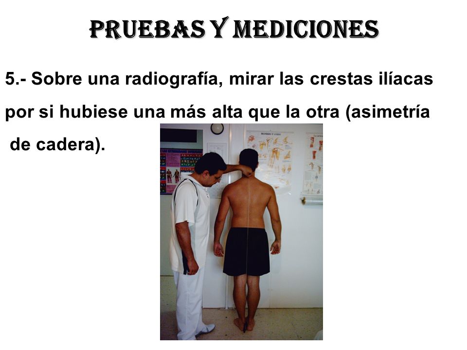 Pruebas y mediciones 5.- Sobre una radiografía, mirar las crestas ilíacas. por si hubiese una más alta que la otra (asimetría.