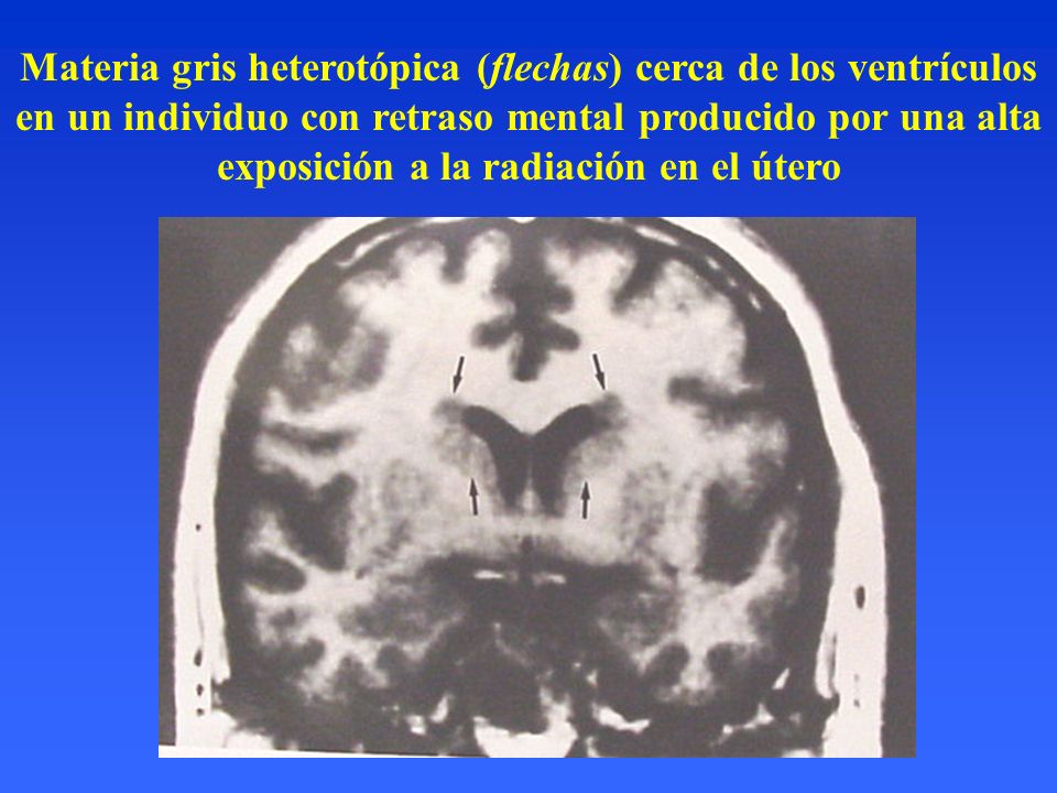 Materia gris heterotópica (flechas) cerca de los ventrículos en un individuo con retraso mental producido por una alta exposición a la radiación en el útero