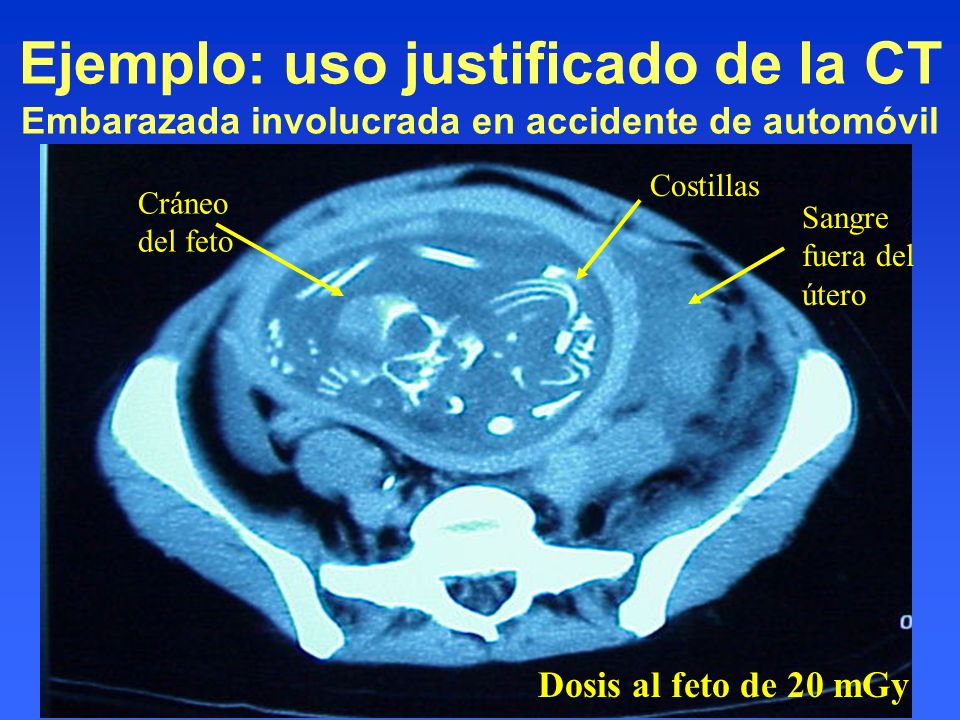Ejemplo: uso justificado de la CT Embarazada involucrada en accidente de automóvil