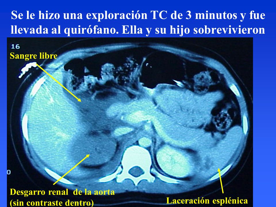 Se le hizo una exploración TC de 3 minutos y fue llevada al quirófano