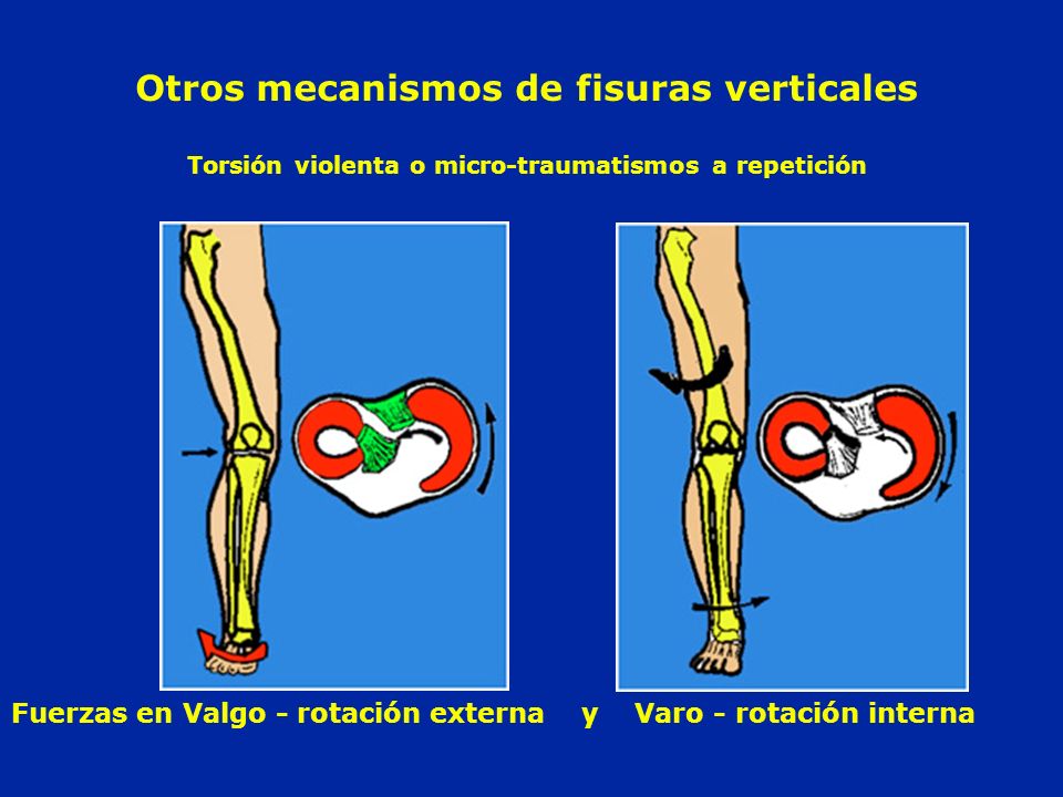 Otros mecanismos de fisuras verticales Torsión violenta o micro-traumatismos a repetición