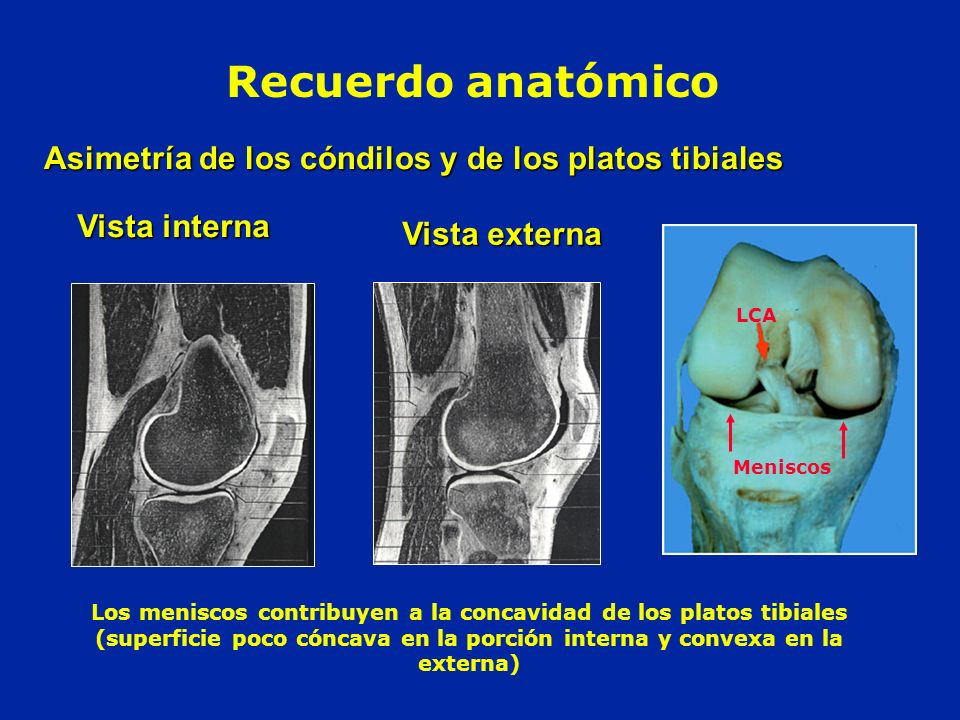 Recuerdo anatómico Asimetría de los cóndilos y de los platos tibiales