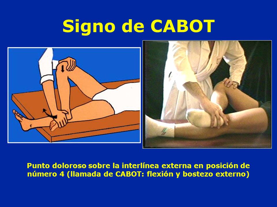 Signo de CABOT Punto doloroso sobre la interlínea externa en posición de número 4 (llamada de CABOT: flexión y bostezo externo)