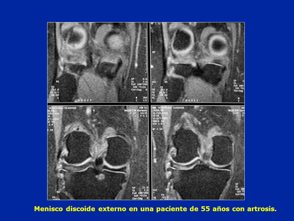 Menisco discoide externo en una paciente de 55 años con artrosis.