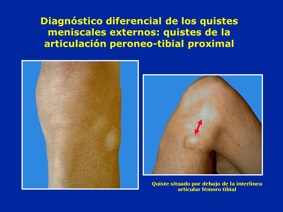 Quiste situado por debajo de la interlinea articular fémoro tibial