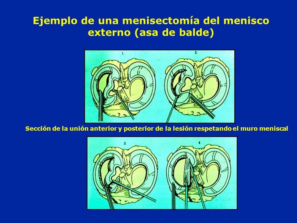 Ejemplo de una menisectomía del menisco externo (asa de balde)