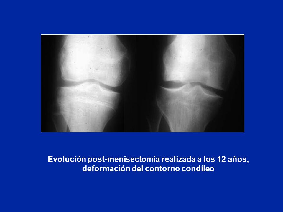 Evolución post-menisectomía realizada a los 12 años, deformación del contorno condíleo