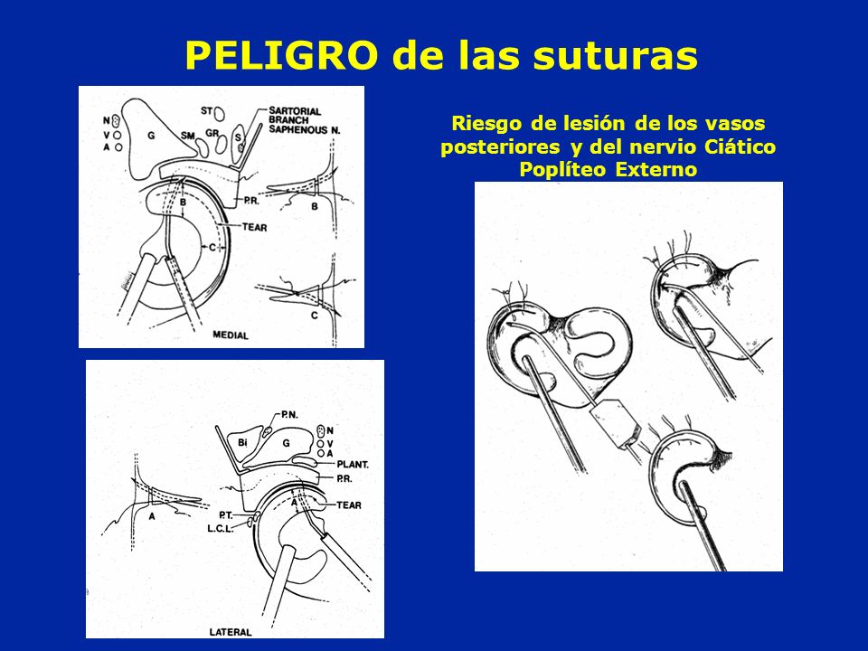 PELIGRO de las suturas Riesgo de lesión de los vasos posteriores y del nervio Ciático Poplíteo Externo.