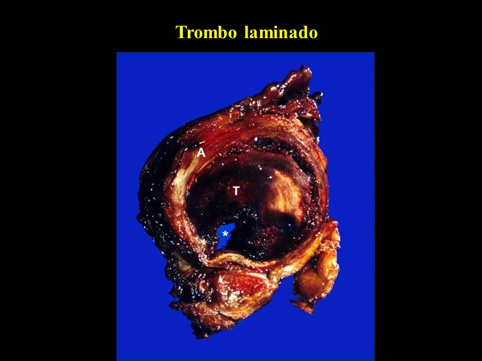 Trombo laminado