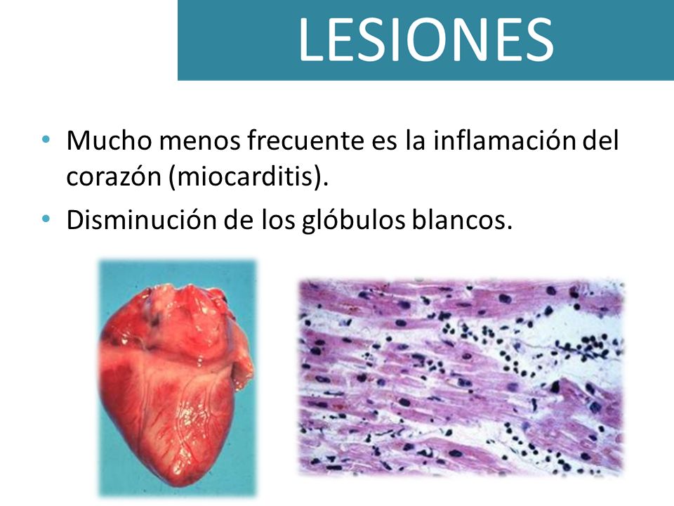 Mucho menos frecuente es la inflamación del corazón (miocarditis).