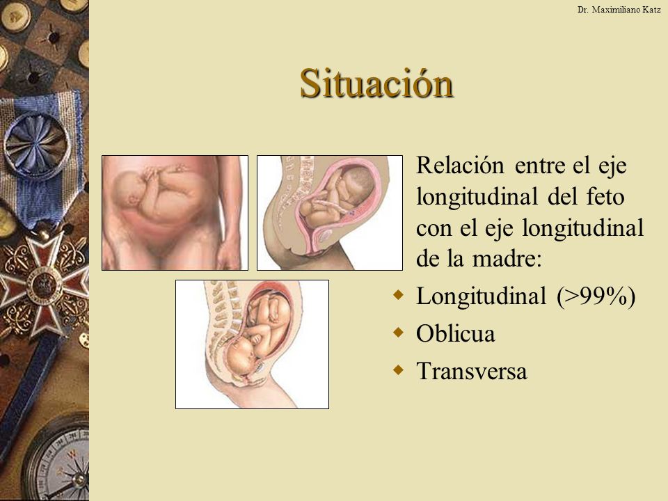 Dr. Maximiliano Katz Situación. Relación entre el eje longitudinal del feto con el eje longitudinal de la madre: