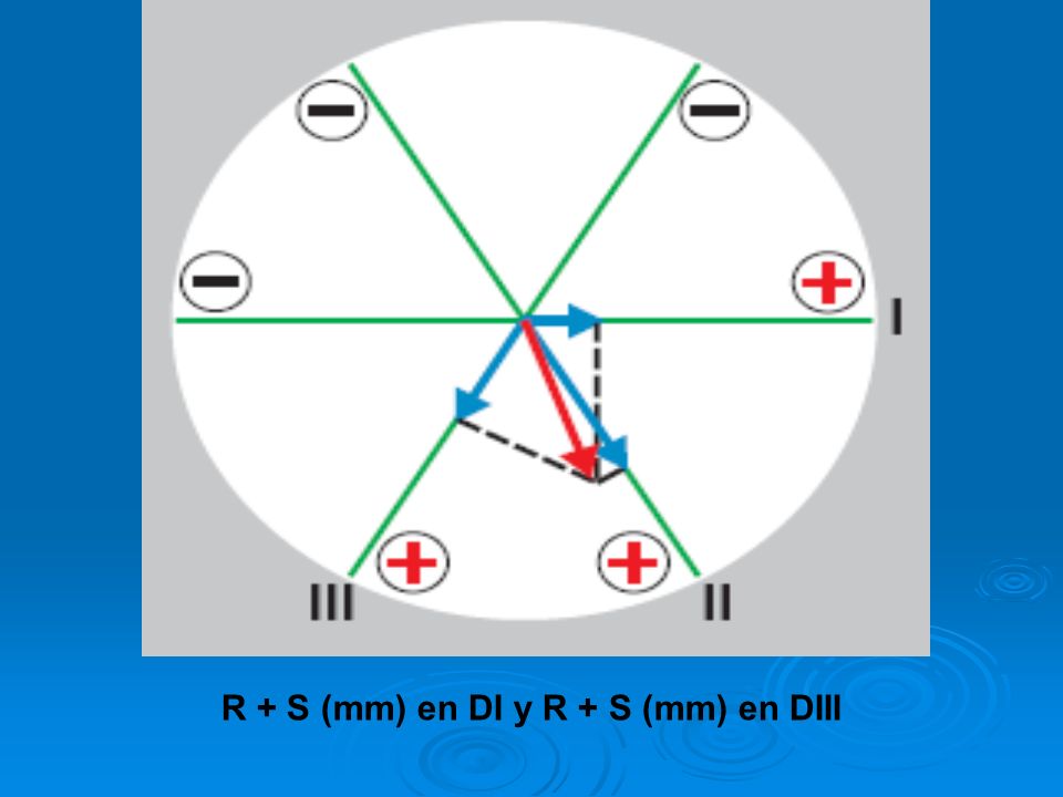 R + S (mm) en DI y R + S (mm) en DIII