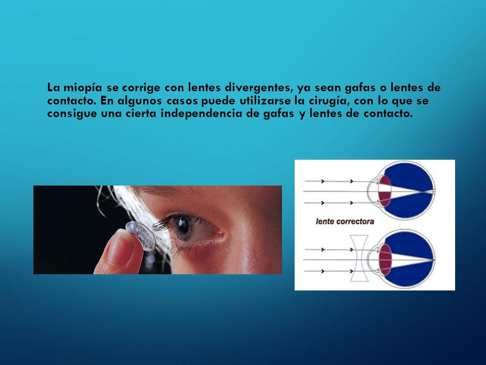 La miopía se corrige con lentes divergentes, ya sean gafas o lentes de contacto.
