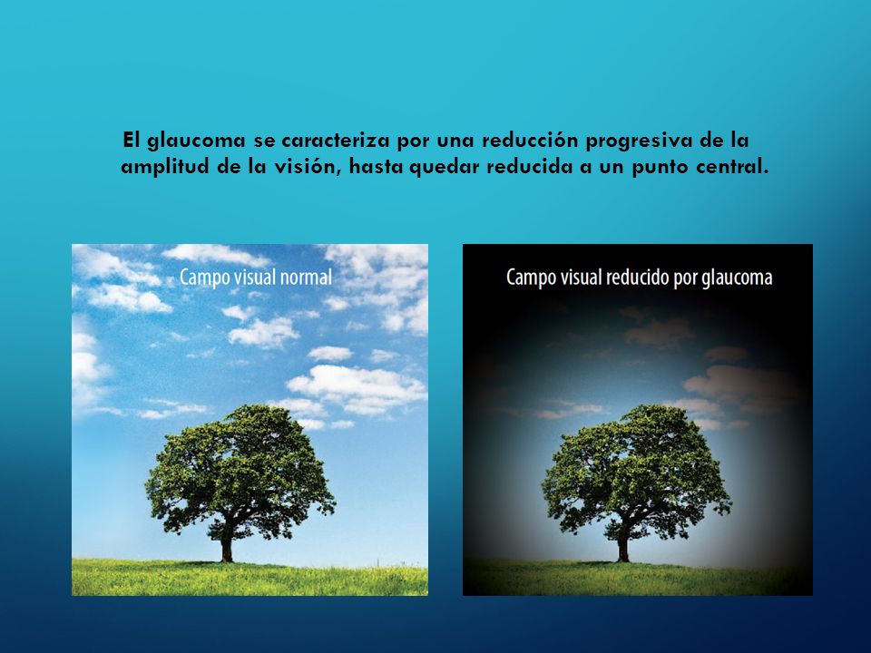 El glaucoma se caracteriza por una reducción progresiva de la amplitud de la visión, hasta quedar reducida a un punto central.