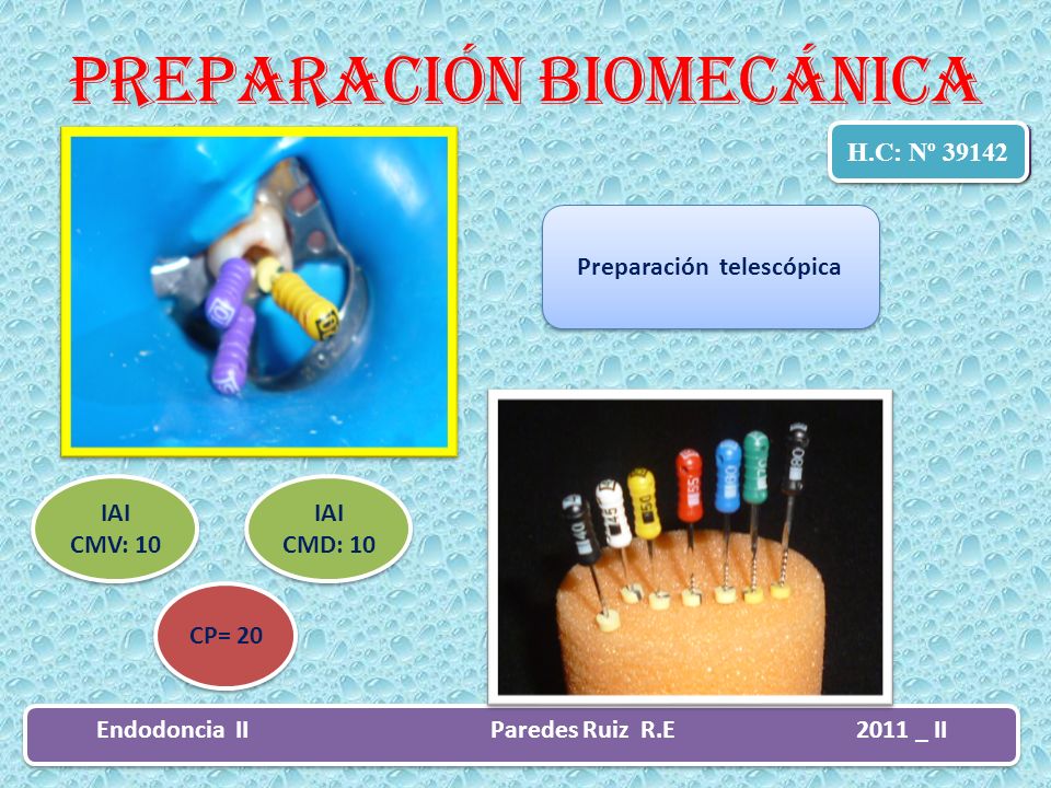 Preparación telescópica Endodoncia II Paredes Ruiz R.E 2011 _ II