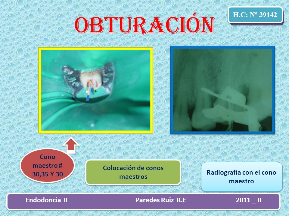 Obturación H.C: Nº H.C: Nº Cono maestro # 30,35 Y 30