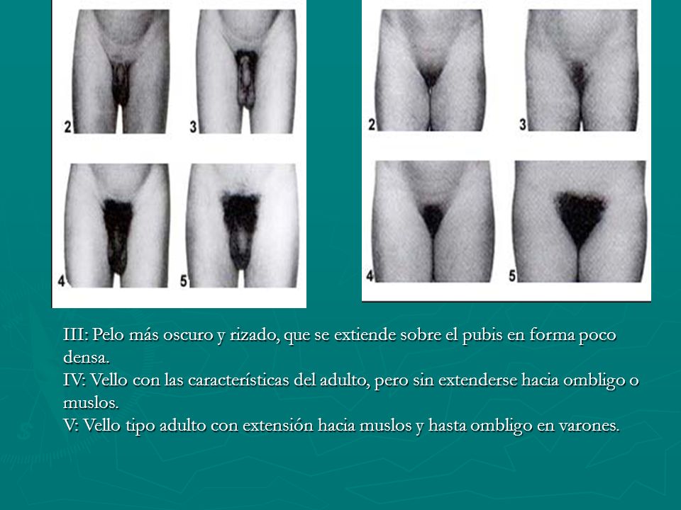 III: Pelo más oscuro y rizado, que se extiende sobre el pubis en forma poco densa.