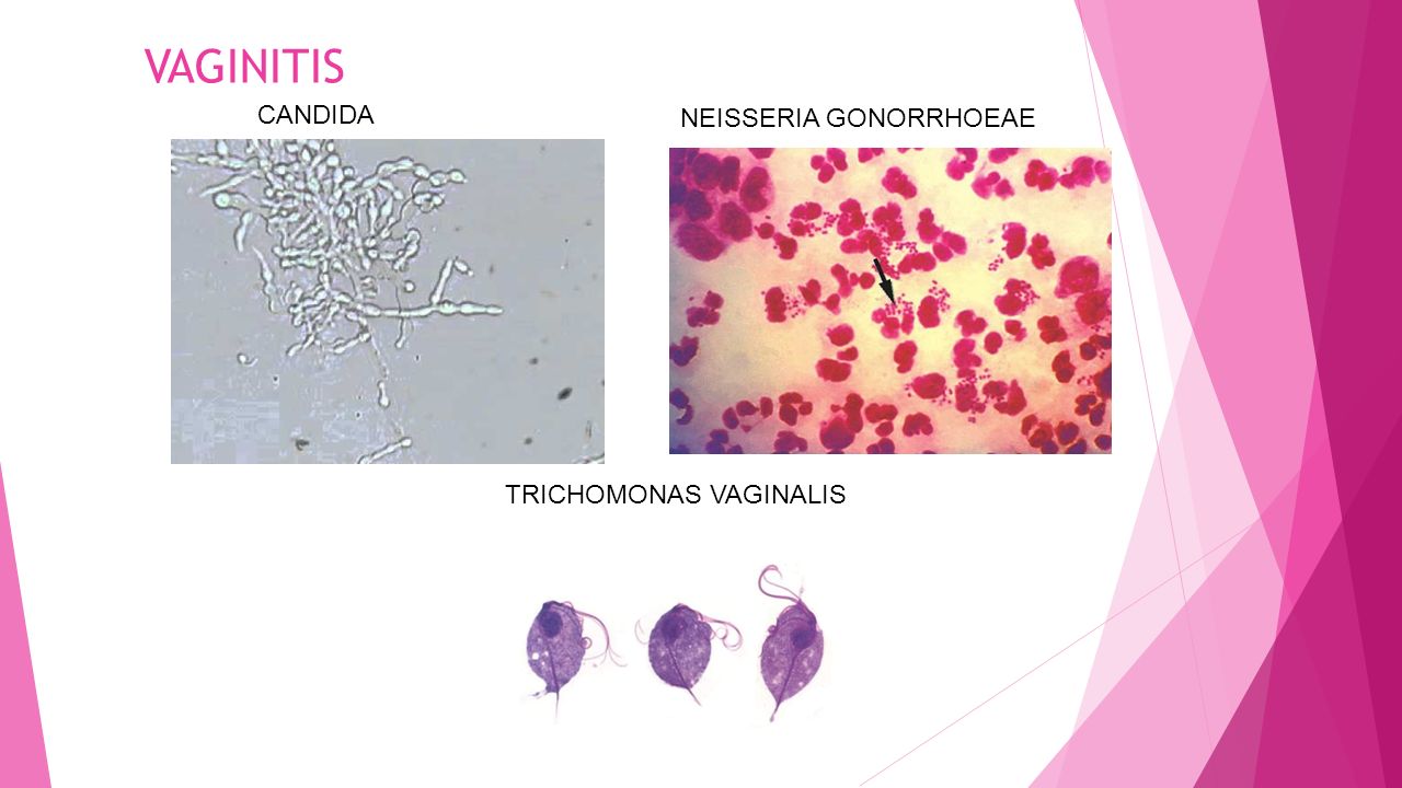 VAGINITIS CANDIDA NEISSERIA GONORRHOEAE TRICHOMONAS VAGINALIS