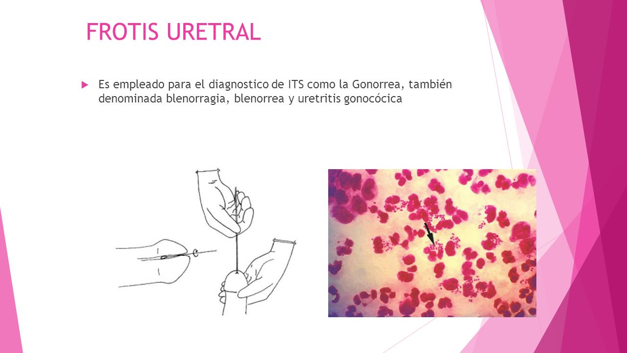FROTIS URETRAL Es empleado para el diagnostico de ITS como la Gonorrea, también denominada blenorragia, blenorrea y uretritis gonocócica.