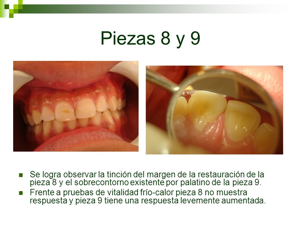 Piezas 8 y 9 Se logra observar la tinción del margen de la restauración de la pieza 8 y el sobrecontorno existente por palatino de la pieza 9.