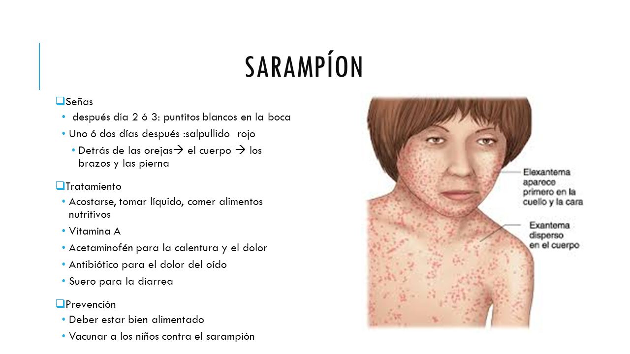 Sarampíon Señas después día 2 ó 3: puntitos blancos en la boca