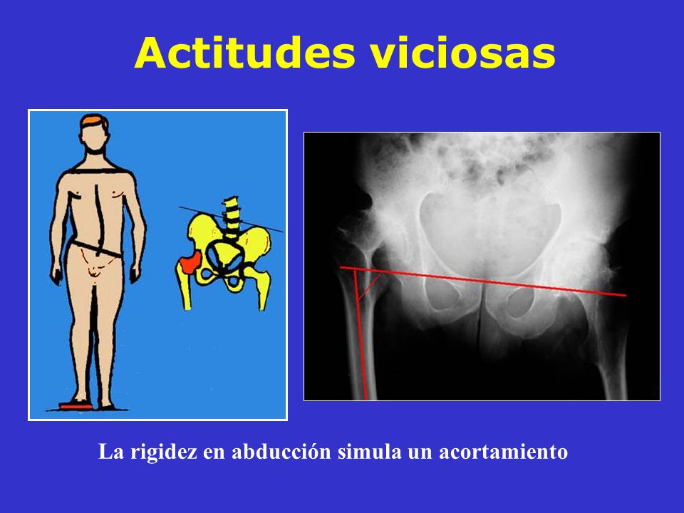 La rigidez en abducción simula un acortamiento
