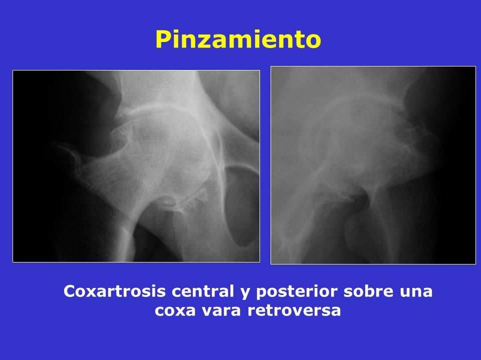 Coxartrosis central y posterior sobre una coxa vara retroversa