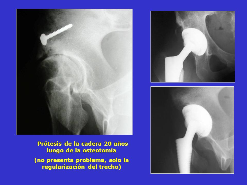 Prótesis de la cadera 20 años luego de la osteotomía