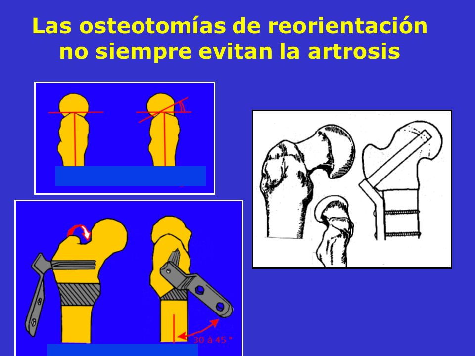 Las osteotomías de reorientación no siempre evitan la artrosis