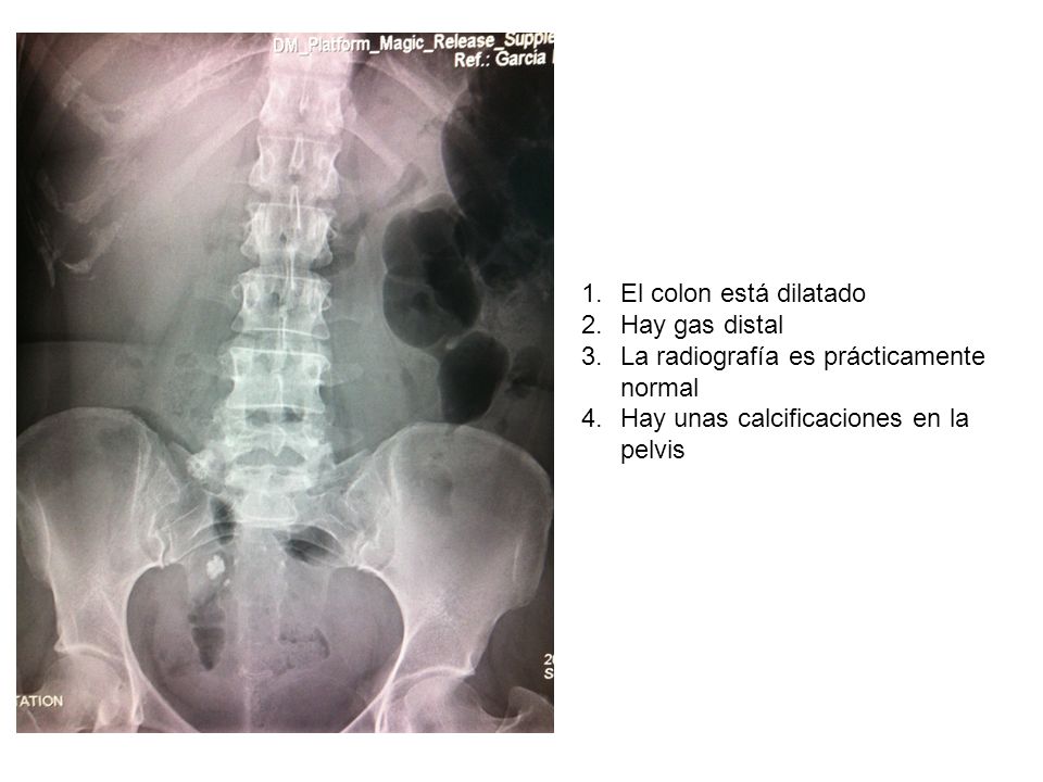 El colon está dilatado Hay gas distal. La radiografía es prácticamente normal.