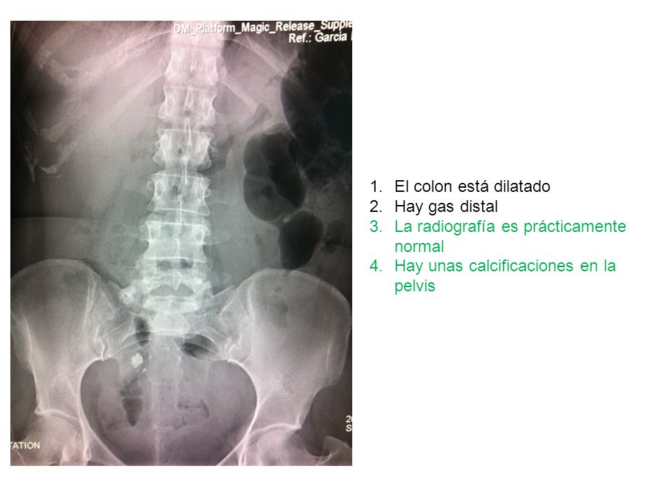 El colon está dilatado Hay gas distal. La radiografía es prácticamente normal.