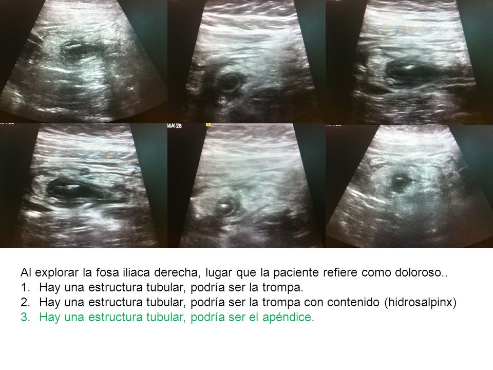 Al explorar la fosa iliaca derecha, lugar que la paciente refiere como doloroso..