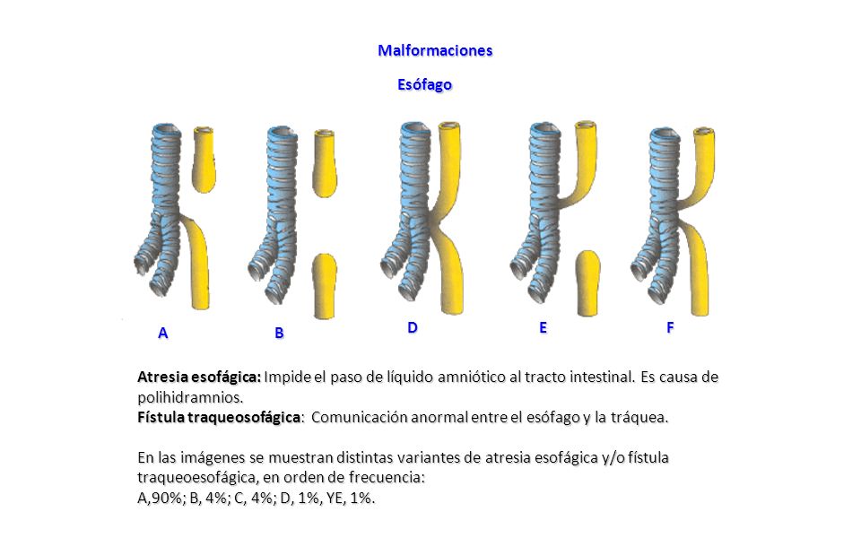 Malformaciones Esófago. D. E. F. A. B. Atresia esofágica: Impide el paso de líquido amniótico al tracto intestinal. Es causa de polihidramnios.