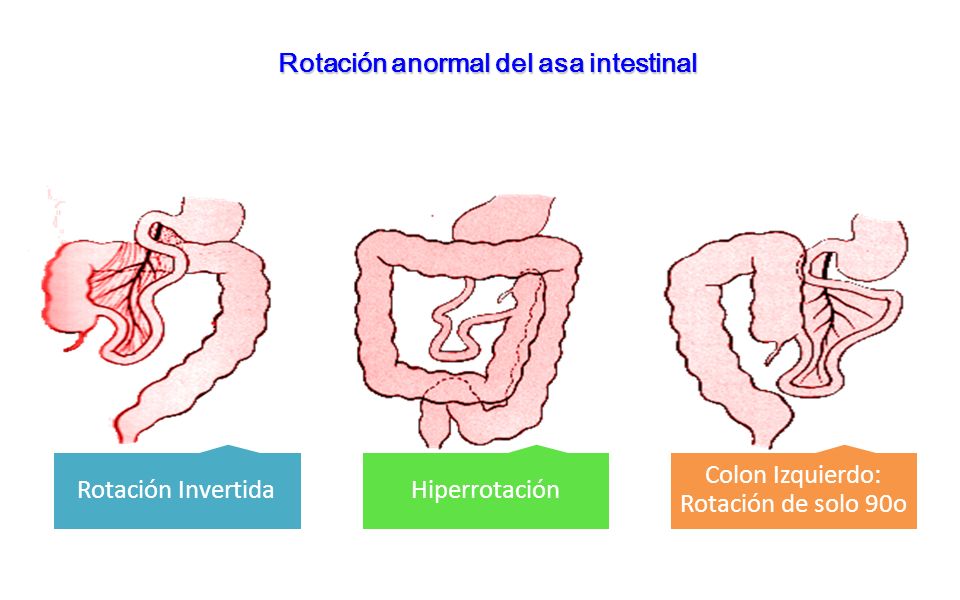 Colon Izquierdo: Rotación de solo 90o