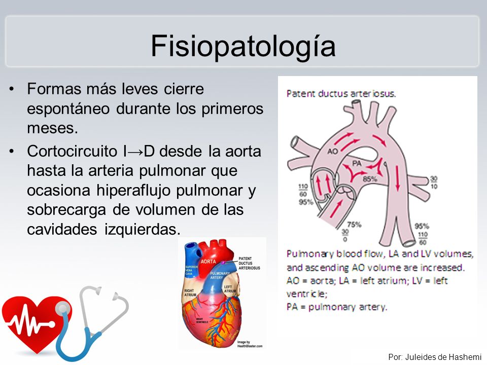 Fisiopatología Formas más leves cierre espontáneo durante los primeros meses.