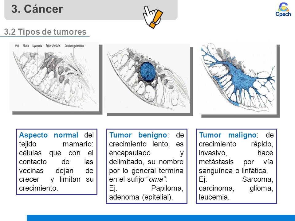 3. Cáncer 3.2 Tipos de tumores