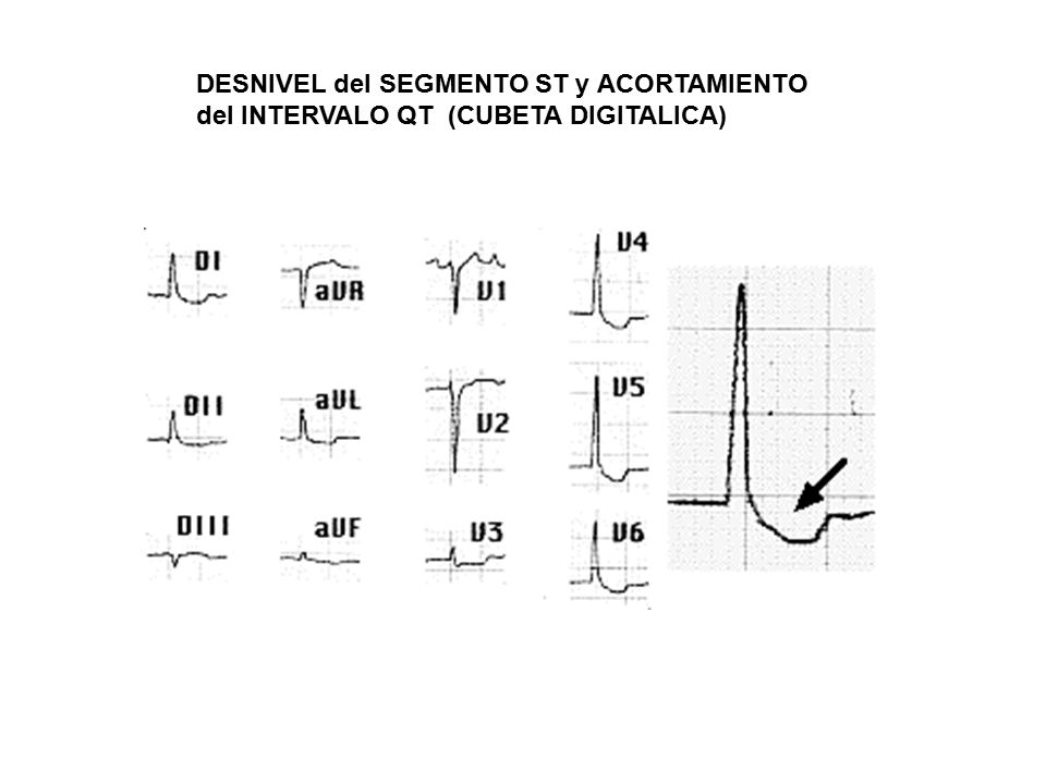DESNIVEL del SEGMENTO ST y ACORTAMIENTO del INTERVALO QT (CUBETA DIGITALICA)