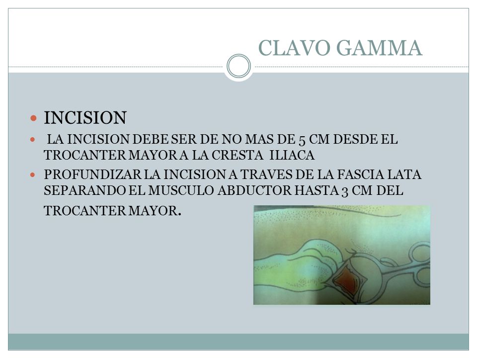 CLAVO GAMMA INCISION. LA INCISION DEBE SER DE NO MAS DE 5 CM DESDE EL TROCANTER MAYOR A LA CRESTA ILIACA.