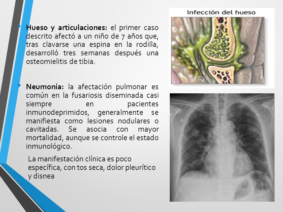 Hueso y articulaciones: el primer caso descrito afectó a un niño de 7 años que, tras clavarse una espina en la rodilla, desarrolló tres semanas después una osteomielitis de tibia.