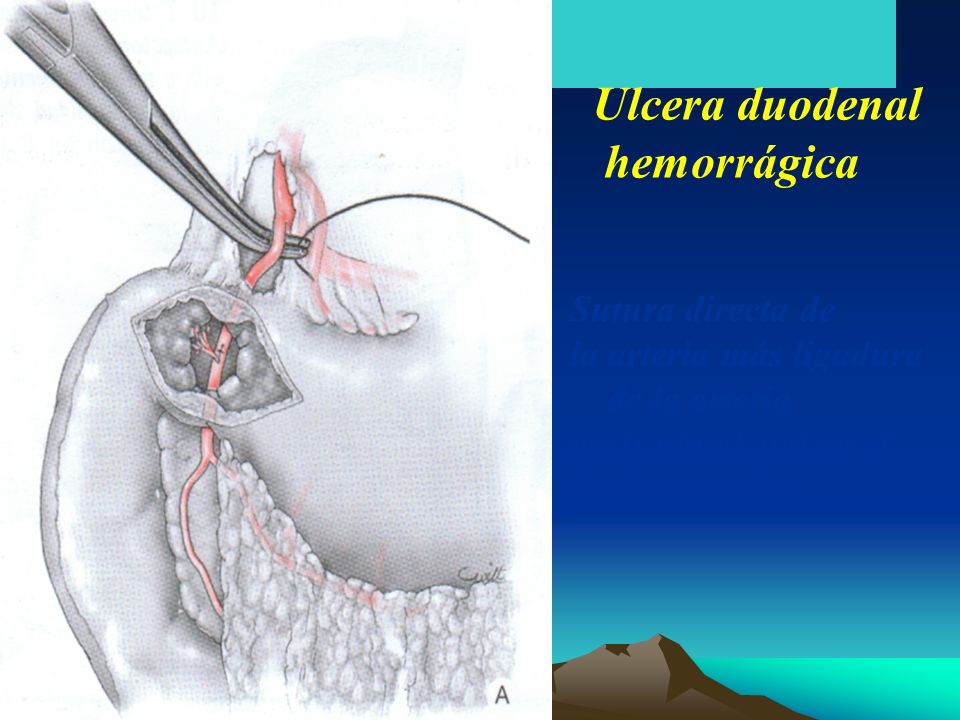 Ulcera duodenal hemorrágica Sutura directa de la arteria más ligadura