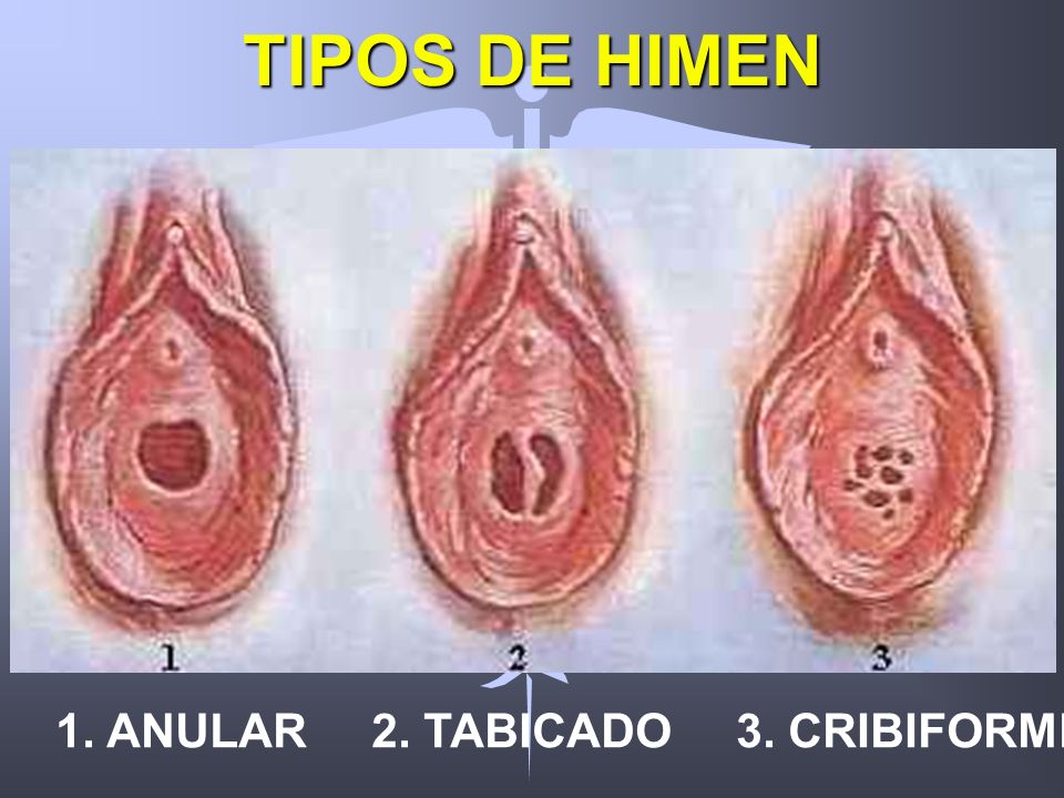 TIPOS DE HIMEN 1. ANULAR 2. TABICADO 3. CRIBIFORME