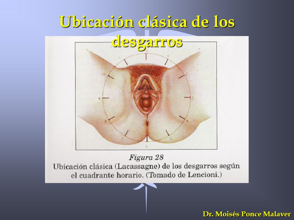 Ubicación clásica de los desgarros