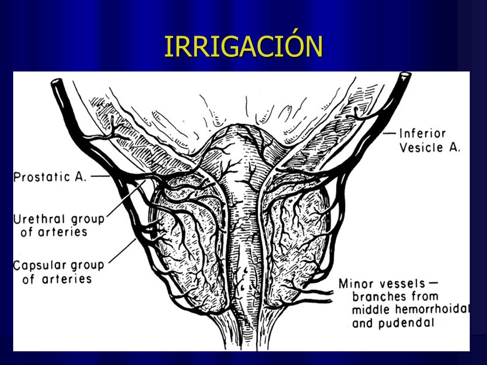 irrigación de la próstata)