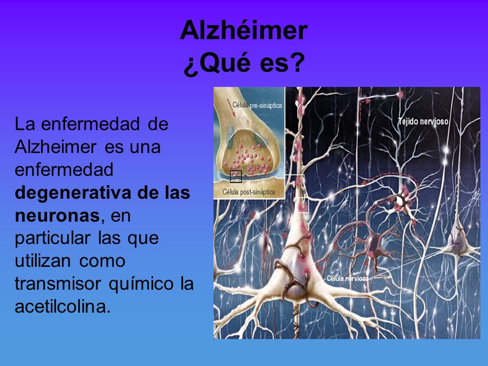 Alzhéimer ¿Qué es La enfermedad de Alzheimer es una enfermedad