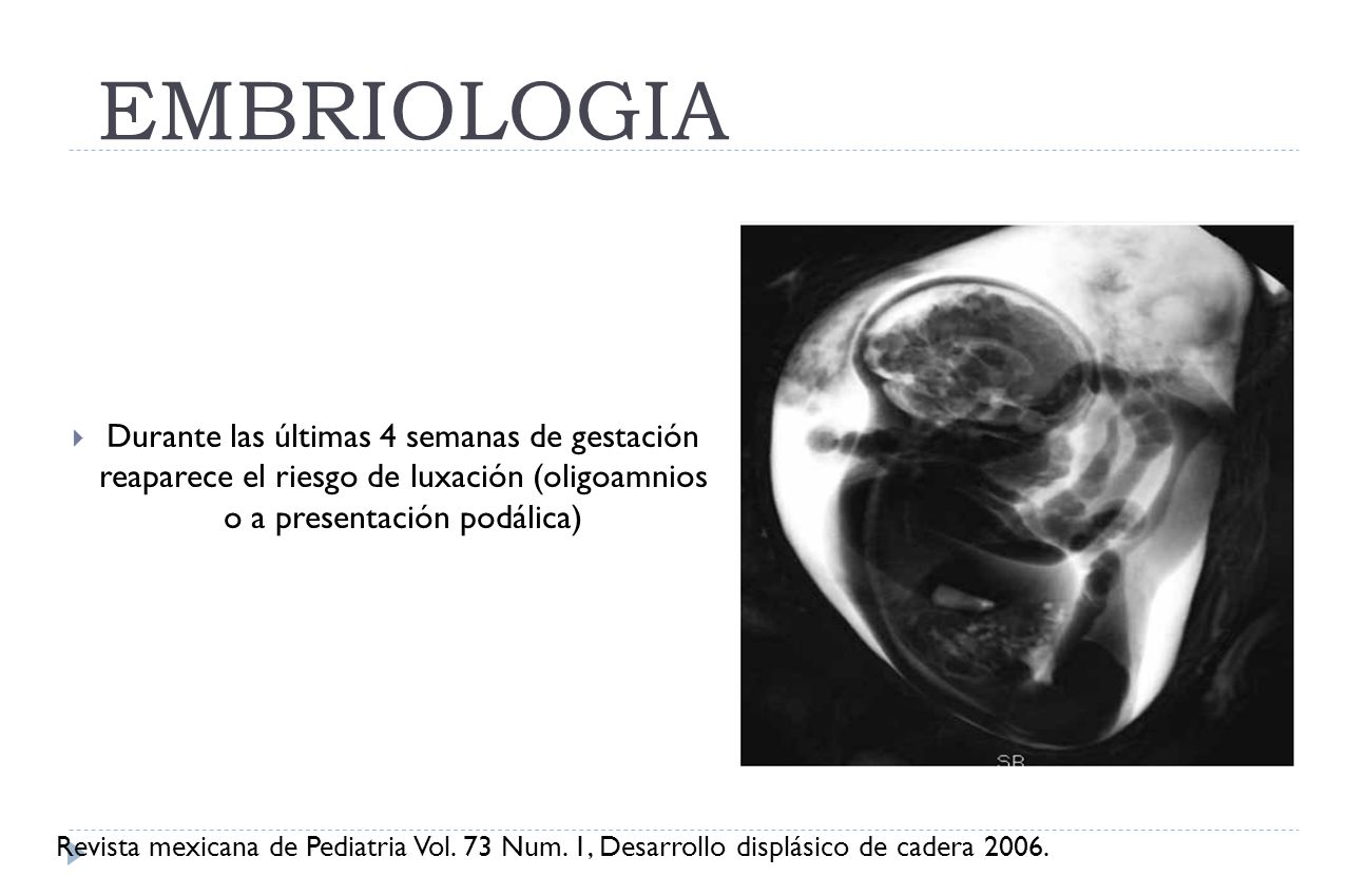 EMBRIOLOGIA Durante las últimas 4 semanas de gestación reaparece el riesgo de luxación (oligoamnios o a presentación podálica)