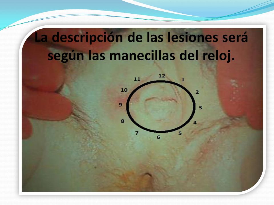 La descripción de las lesiones será según las manecillas del reloj.