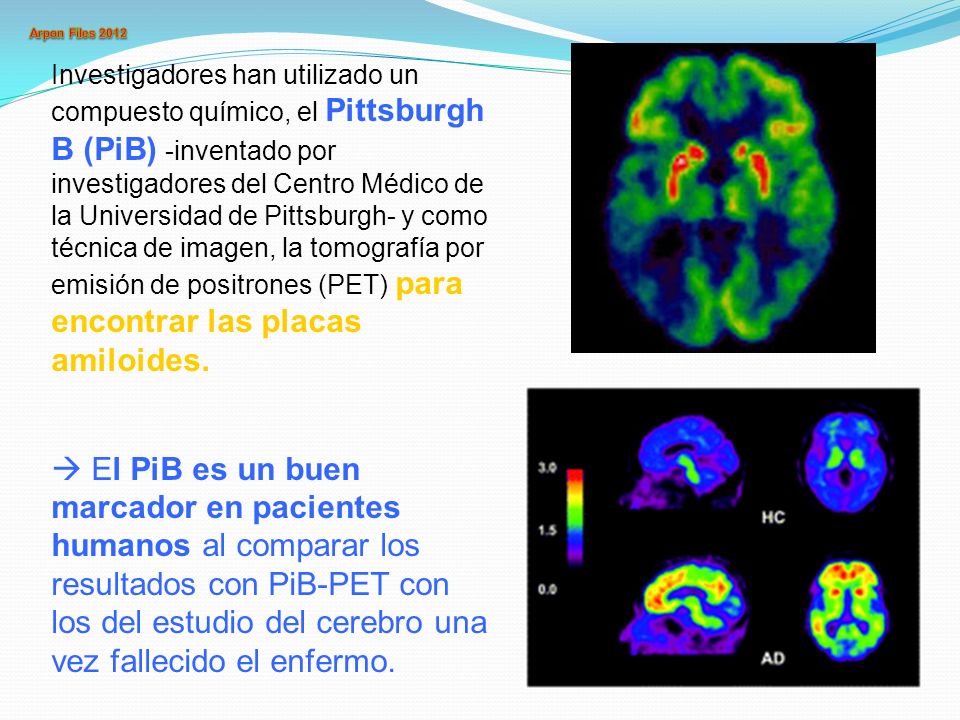 Investigadores han utilizado un compuesto químico, el Pittsburgh B (PiB) -inventado por investigadores del Centro Médico de la Universidad de Pittsburgh- y como técnica de imagen, la tomografía por emisión de positrones (PET) para encontrar las placas amiloides.