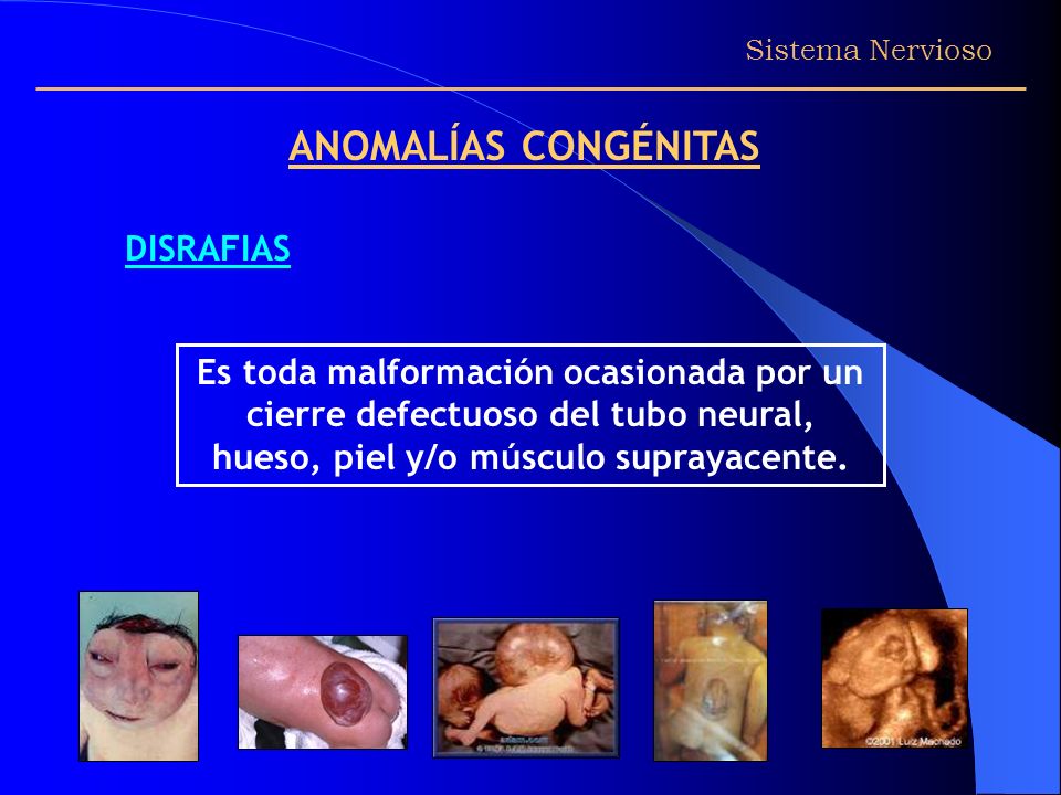 ANOMALÍAS CONGÉNITAS DISRAFIAS